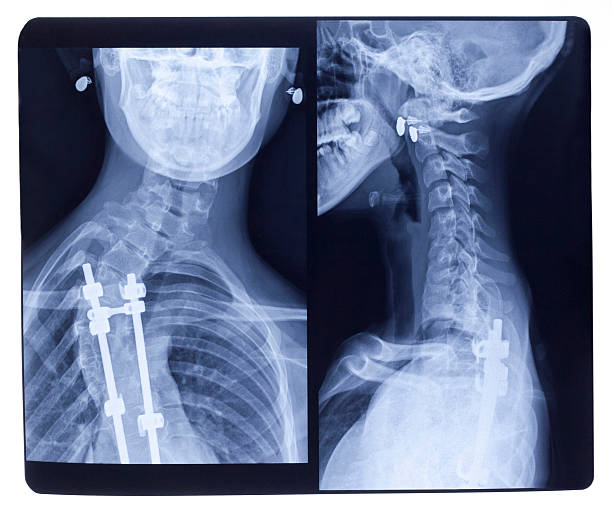 x-ray scoliosis - libs stock-fotos und bilder