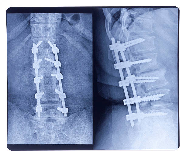 scoliosis, x-ray - libs stock-fotos und bilder