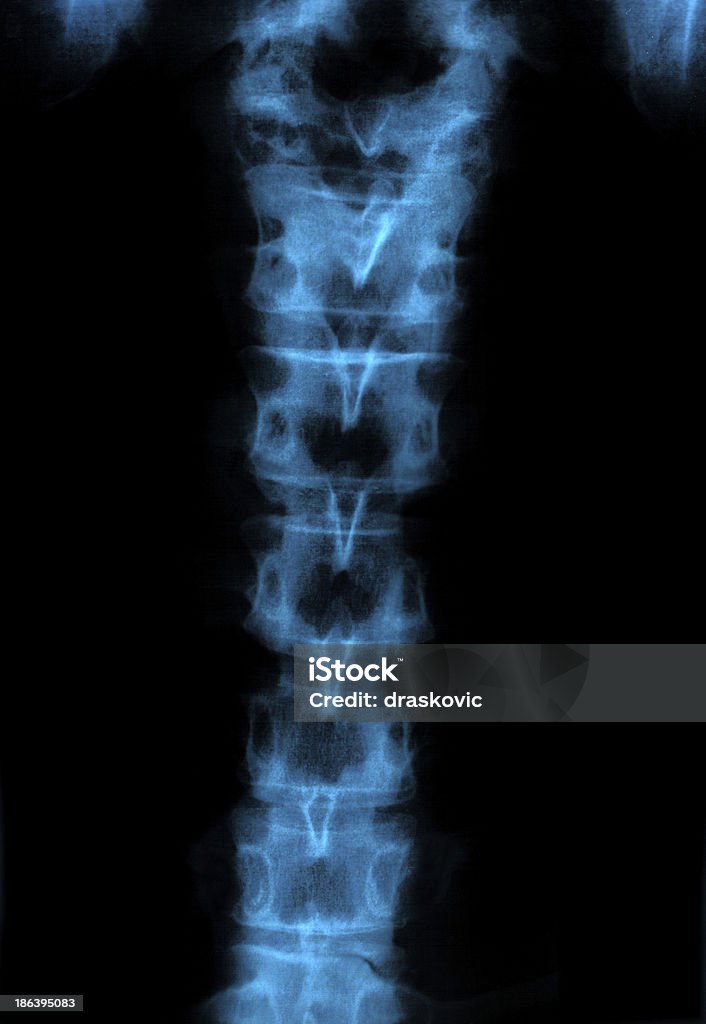 X-레이 인간 척추 뼈 - 로열티 프리 X-레이 스톡 사진
