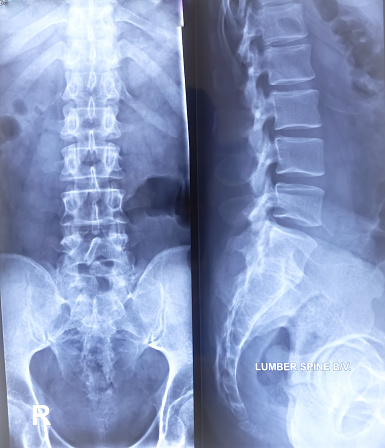 Lumbo sacral (LS) spine x-ray both view. Straightining of lumber lordotic curvature. Early degenerative change at lumber spine. Marginal osteophytes are noted in lumber vertebrae. Sacralization.
