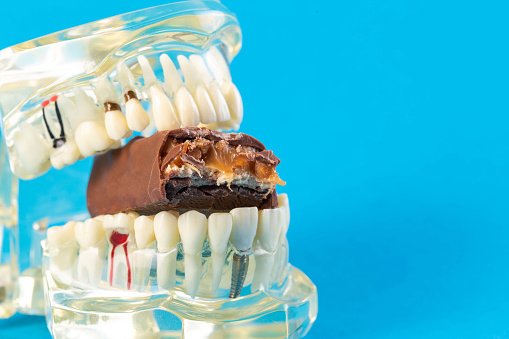 A bitten piece of chocolate in a dental jaw mockup on a blue background. The concept of the effect of sugar and leftover food on teeth and tooth enamel. Tooth destruction by bacteria, caries, pulpitis. Copy space for text