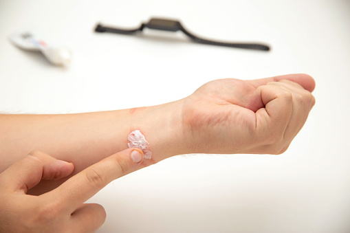 Applying a medicinal ointment to the redness of the wrist against the background of a fitness bracelet with a silicone strap. Allergy and contact dermatitis concept.