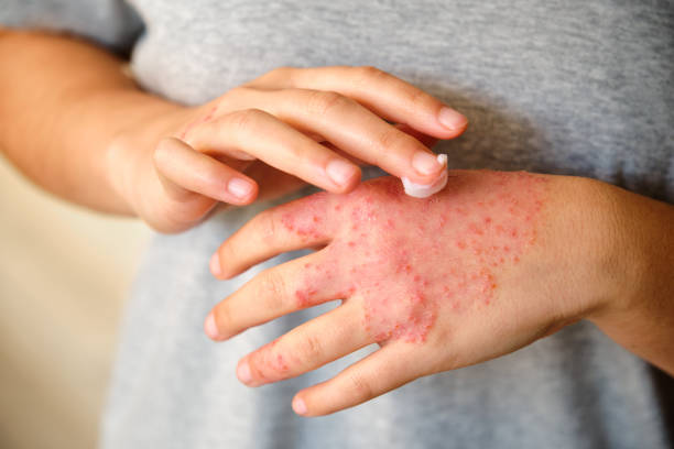 Woman applying ointment or moisturizing cream in the eczema, atopic dermatitis. Unrecognizable woman applying ointment or moisturizing cream in the treatment of eczema on hand, atopic dermatitis. photo psoriasis stock pictures, royalty-free photos & images