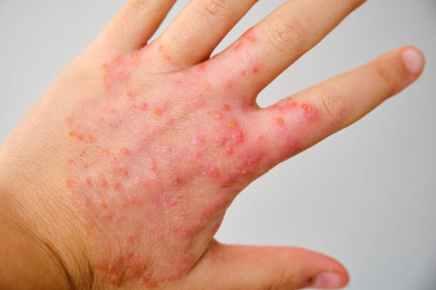 istock Close up of a hand with eczema, atopic dermatitis. 1864571446