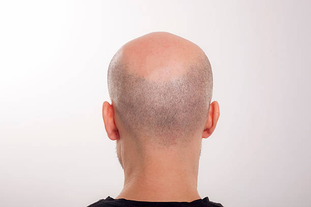 バックを実現 - bald patch ストックフォトと画像