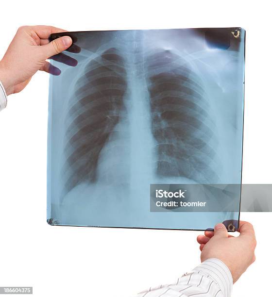 Xray Of The Hands Stock Photo - Download Image Now - Black Color, Data, Doctor