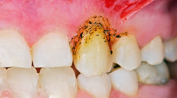 Gingivoplasty procedure Gingivoplasty procedure . Selective focus. gingivoplasty stock pictures, royalty-free photos & images