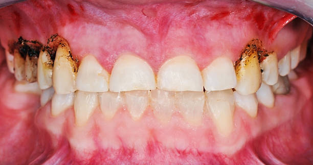 Gingivoplasty procedure Gingivoplasty procedure . Selective focus. gingivoplasty stock pictures, royalty-free photos & images