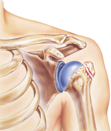 Anatomy of the bones and joints of a shoulder with a broken greater tubercle.