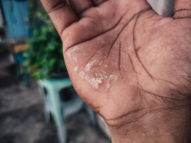 istock irritated and peeling skin on the hands 1867031993
