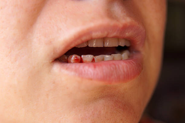 bleeding gums stock photo