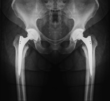 Xray of the pelvis after two hips replacement. The hip joint is replaced by a prosthetic implant.