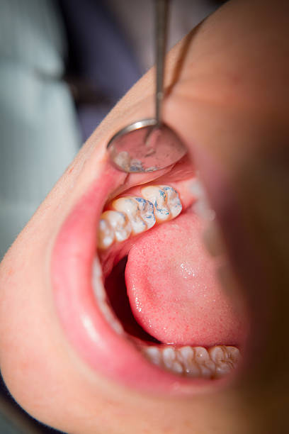 mujer joven obtener un llenado - mouth open dental drill holding doctor fotografías e imágenes de stock