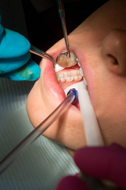 jovem mulher ficando um preenchimento - mouth open dental drill holding doctor - fotografias e filmes do acervo