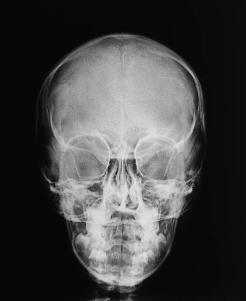 x-ray-totenköpfen - augenhöhle stock-fotos und bilder
