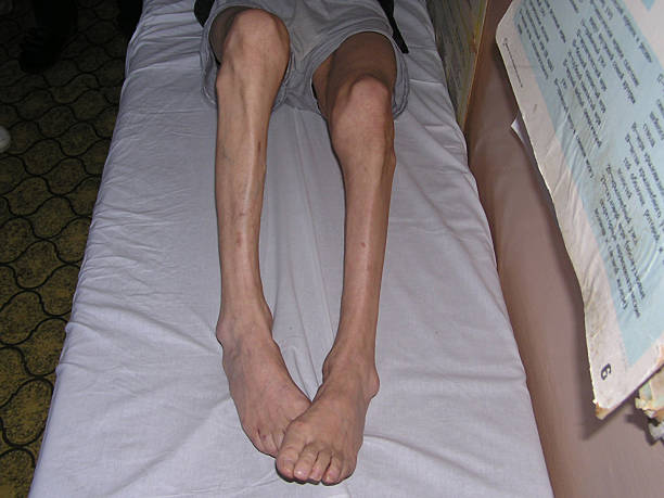 Atrophy of legs "These are legs of a patient 45 years old with neural diseases, because of which the muscles in his legs have atrophy (destroyed)." atrophy stock pictures, royalty-free photos & images