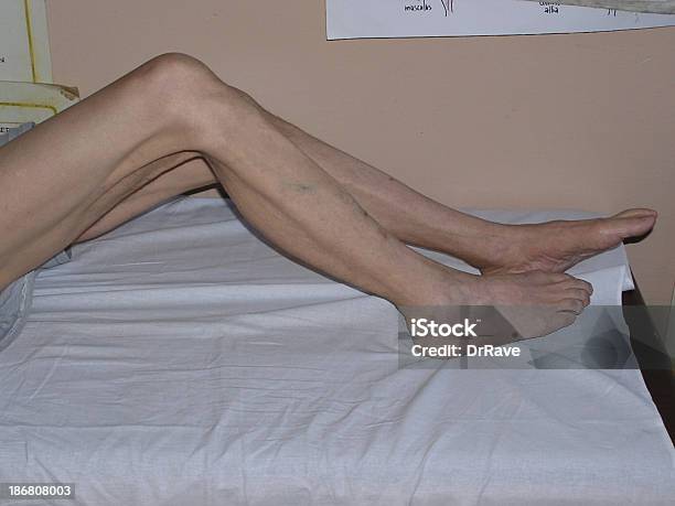 Atrofia De Legs2 - Fotografias de stock e mais imagens de Atrofia - Atrofia, Conceito, Corpo humano