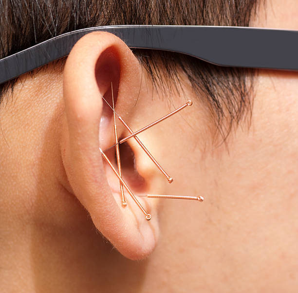 Acupuncture Needles in Ear Closeup of acupuncture needles in a man's ear.Click below for my ACUPUNCTURE lightbox: acupuncture model stock pictures, royalty-free photos & images