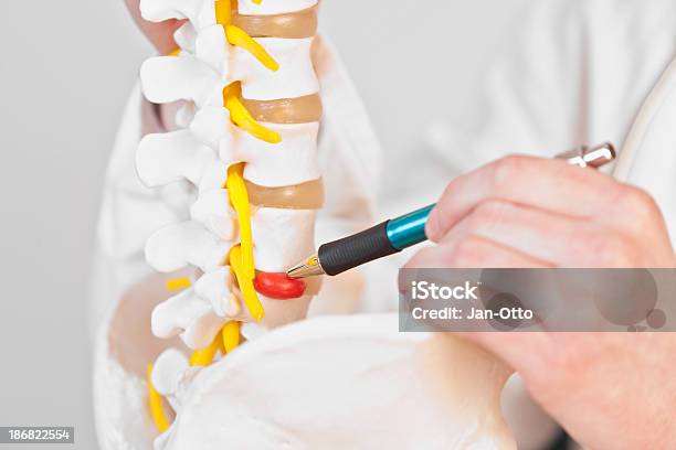 요추 추간판 Herniation 탈장에 대한 스톡 사진 및 기타 이미지 - 탈장, 추간판, 아픔