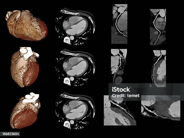 心臓 Ct - CTのストックフォトや画像を多数ご用意 - CT, 冠動脈, トモグラフィー