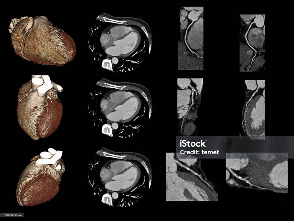 Cardiac CT This is a procedure performed using a multi-slice CT CAT Scan Stock Photo