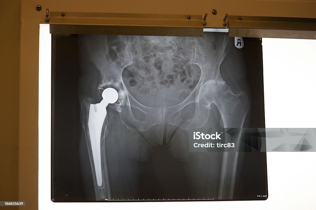 X-ray con sostituzione fianco - Foto stock royalty-free di Arto - Parte del corpo