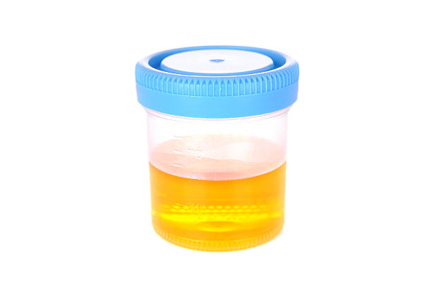 Urine sample in a translucent cup on a white background stock photo