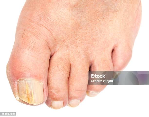 足の爪菌白 - 爪甲真菌症のストックフォトや画像を多数ご用意 - 爪甲真菌症, 菌類, 足の爪