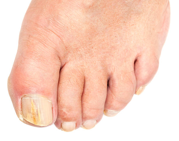 unha do pé fungo (isolada no branco - fungus toenail human foot onychomycosis imagens e fotografias de stock