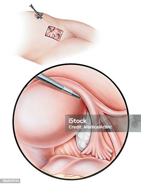 Laparoscopy 診断 - 腹腔鏡下手術のベクターアート素材や画像を多数ご用意 - 腹腔鏡下手術, 婦人科検診, 卵管