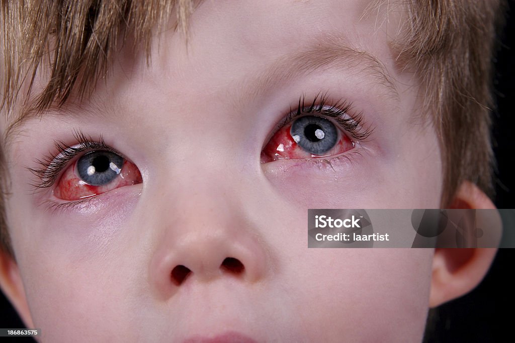 Eye Surgery Recovery 3 Stock Photo - Download Image Now - Sore Eyes,  Swollen, Blood - iStock
