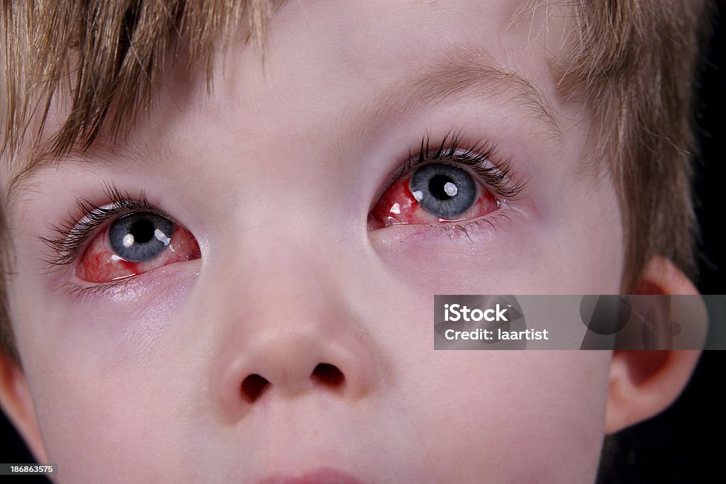 Eye Surgery Recovery 3 Stock Photo - Download Image Now - Sore Eyes, Swollen, Blood - iStock Eye Surgery Recovery 3 Stock Photo - Download Image Now - Sore Eyes, Swollen, Blood - iStock