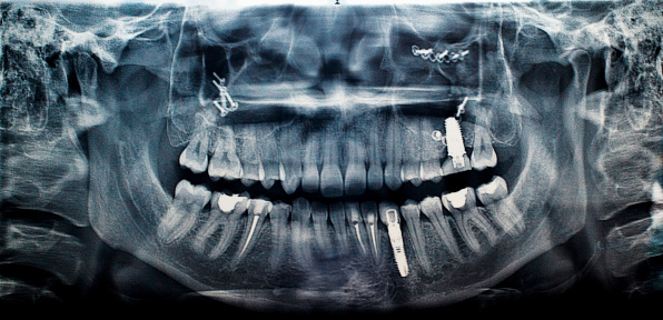 Dental X-ray.