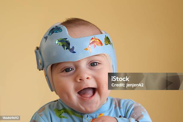 Plagiocephaly Tratamiento Foto de stock y más banco de imágenes de Bebé - Bebé, Casco - Herramientas profesionales, Casco de trabajo