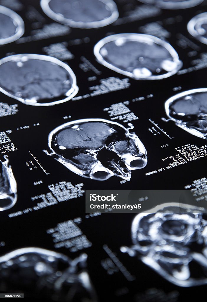 MRI del cerebro - Foto de stock de Cerebro libre de derechos