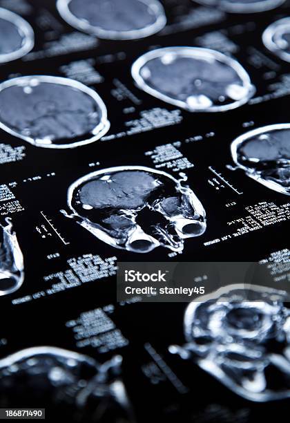 Mri Del Cerebro Foto de stock y más banco de imágenes de Cerebro - Cerebro, Rayos X, Imagen de rayos X