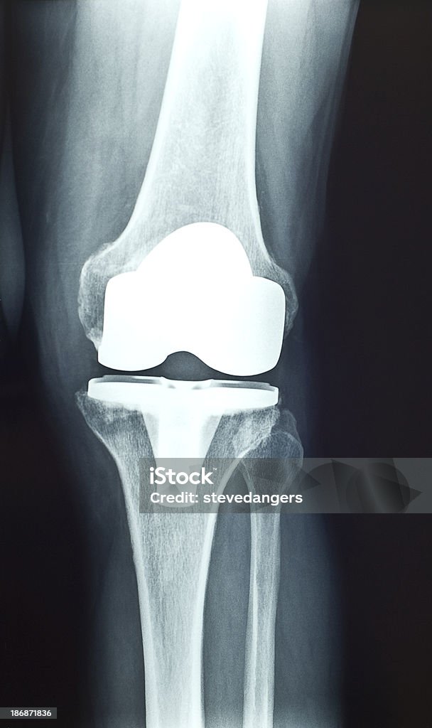 Knie prosthesis x-ray - Lizenzfrei Knie Stock-Foto