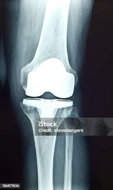 Knie Prosthesis Xray Stockfoto und mehr Bilder von Knie - Knie, Künstliches Gelenk, Prothese
