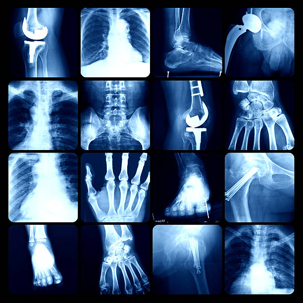 x-ray - rib cage people x ray image x ray foto e immagini stock