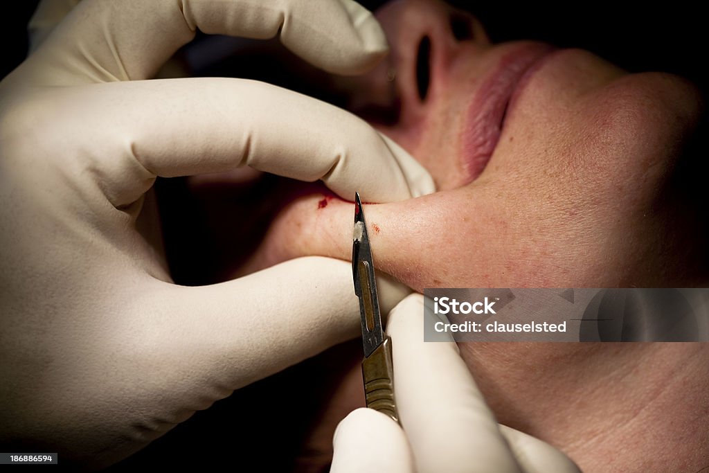 Dermatólogo elimina lunares - Foto de stock de Cirugía plástica libre de derechos
