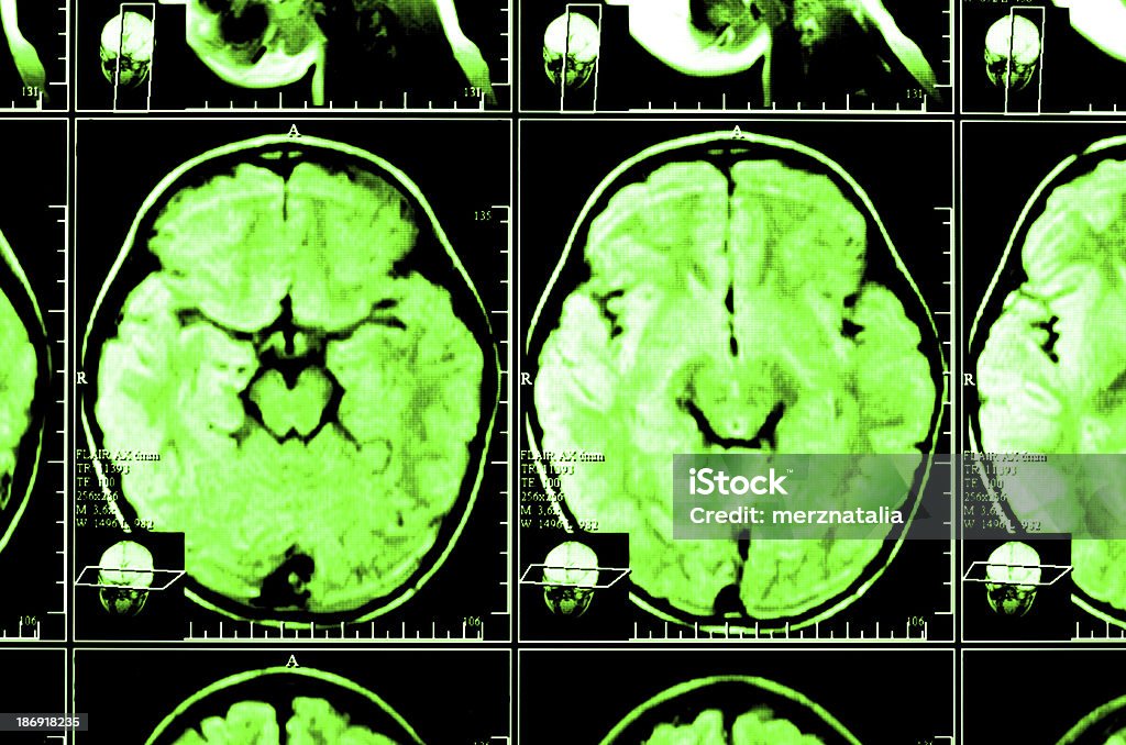 Imagem de raios X de o cérebro computado tomography - Foto de stock de Anatomia royalty-free