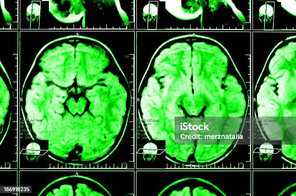 Foto de Imagem De Raios X De O Cérebro Computado Tomography e mais fotos de stock de Anatomia