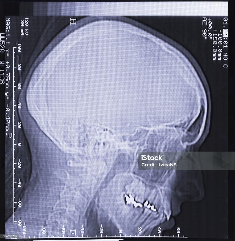 magnetic resonance scan of human head magnetic resonance (MR) scan of brain, skull, head, neck and face Anatomy Stock Photo