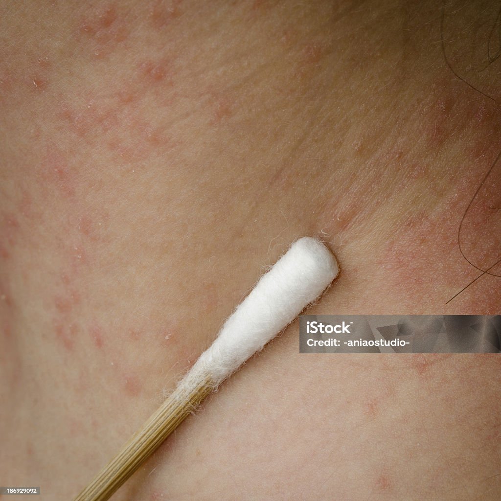 Actual aplicação da droga na psoríases pele - Foto de stock de Alergia royalty-free