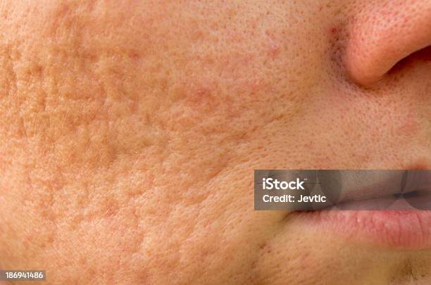 Acne Cicatrici - Fotografie stock e altre immagini di Acne - Acne, Cicatrice, Largo - Descrizione generale