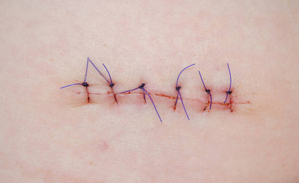 Surgical stitches Surgical suture macro photo Stitch stock pictures, royalty-free photos & images