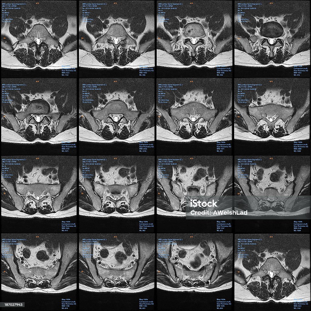 МРТ через раздел срезов в поясничном отделе позвоночника (позвоночника) - Стоковые фото Анатомия роялти-фри
