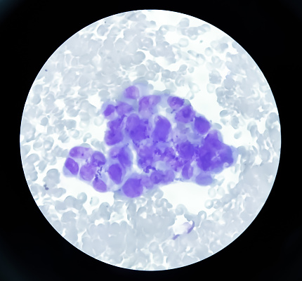 Ascetic fluid cytology, Malignant cells, Metastatic adenocarcinoma