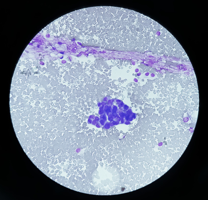 Ascetic fluid cytology, Malignant cells, Metastatic adenocarcinoma