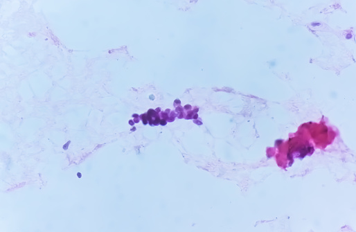 Ascetic fluid cytology, Malignant cells, Metastatic adenocarcinoma